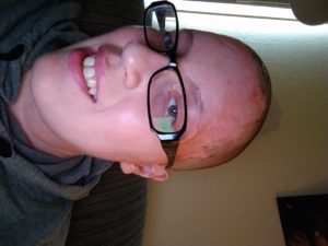 Sharon Pearson - Burn Survivor